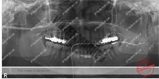 انواع رادیوگرافی و رادیولوژی در دندانپزشکی