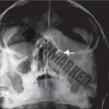 تصاویر رادیوگرافی با اشعه ایکس از سینوس