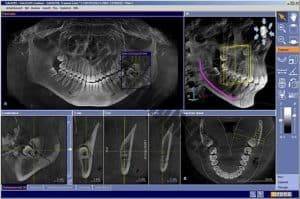 تصاویر رادیوگرافی برای کشیدن دندان عقل