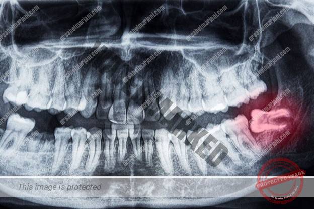 تصاویر رادیوگرافی برای کشیدن دندان عقل