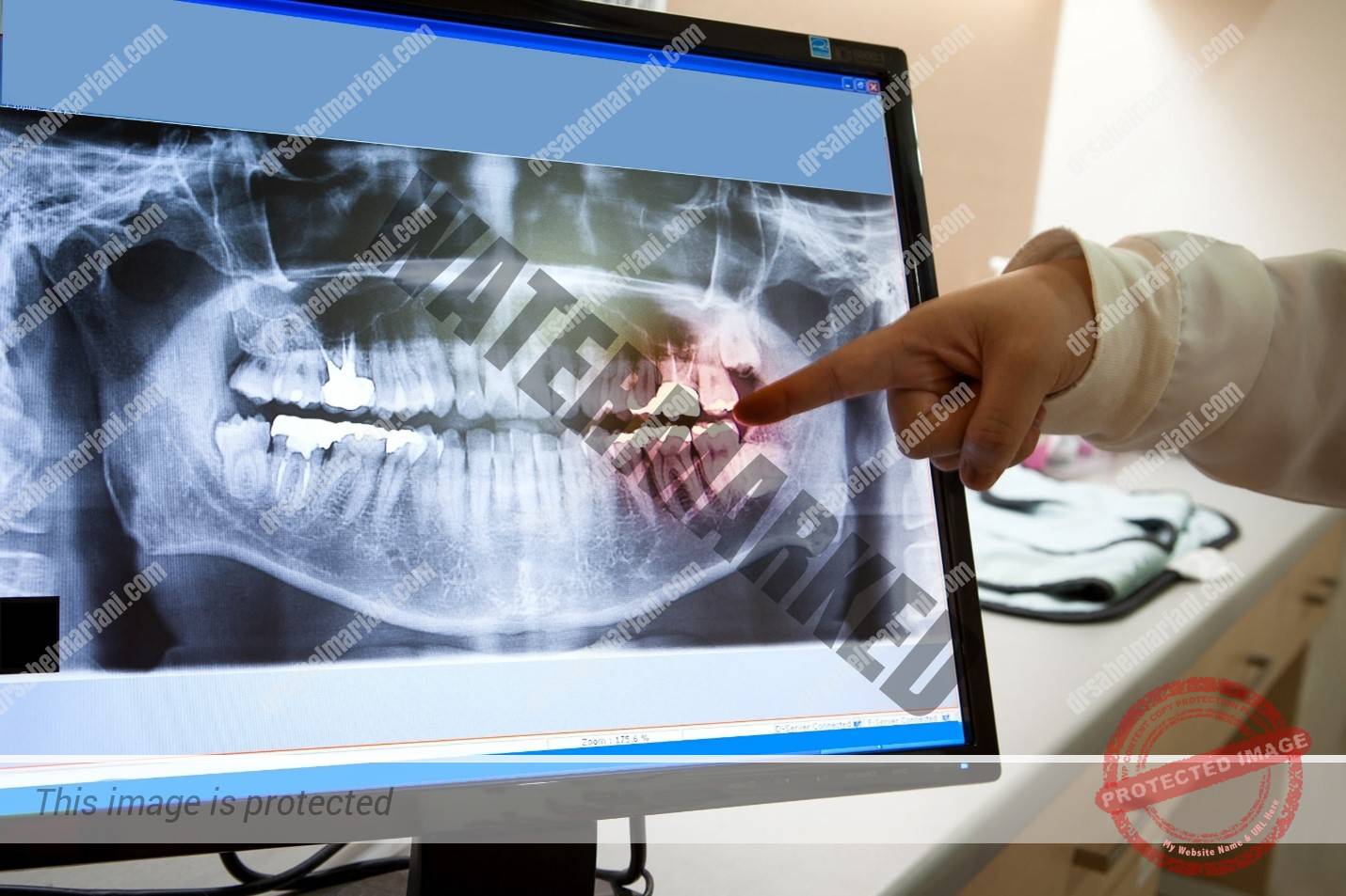 خطرات عکس رادیوگرافی با اشعه ایکس