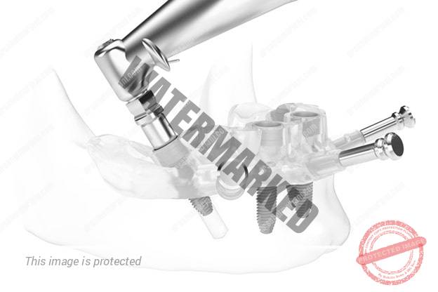 مزایای راهنماهای جراحی کاشت ایمپلنت های دندانی