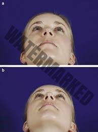 ثبت تصاویر مقایسه ای قبل و بعد از جراحی بینی